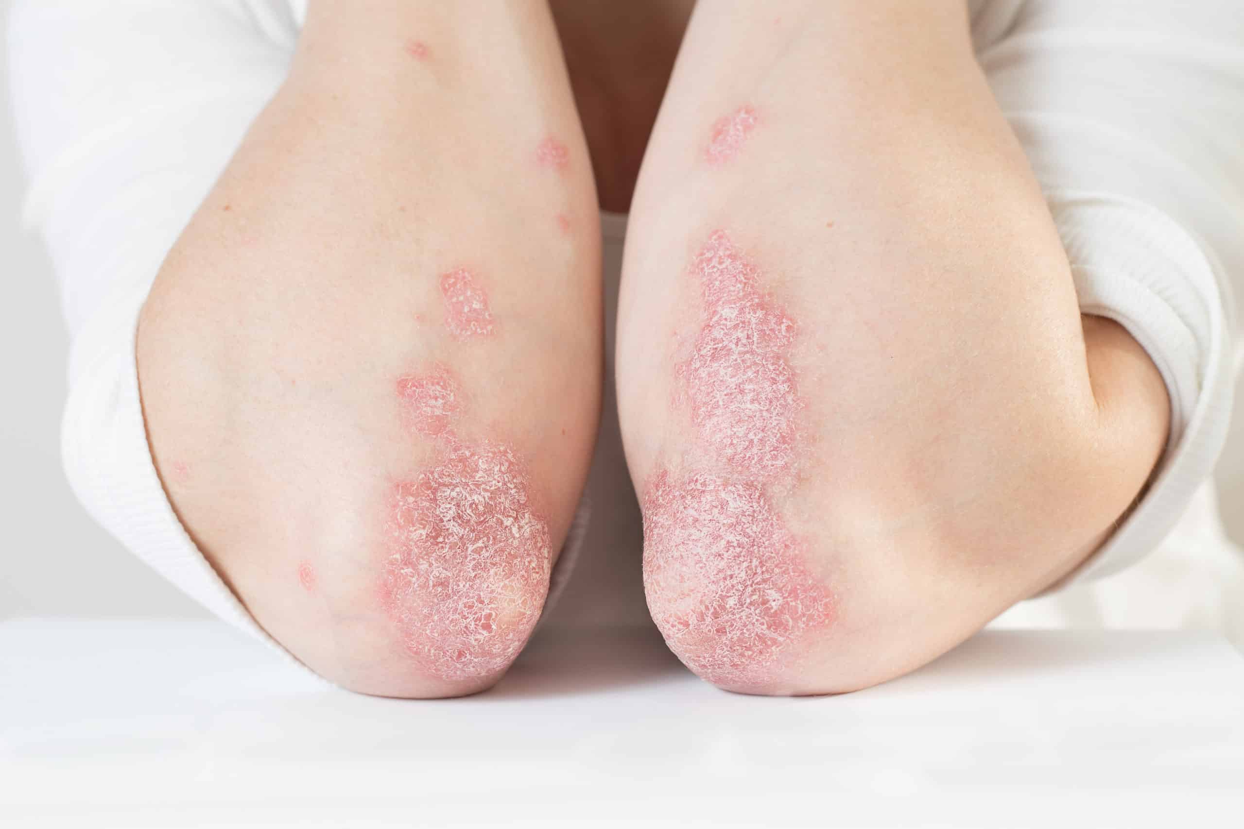 Acute psoriasis on the elbows is an autoimmune incurable dermatological skin disease. Large red, inflamed, flaky rash on the knees. Joints affected by psoriatic arthritis