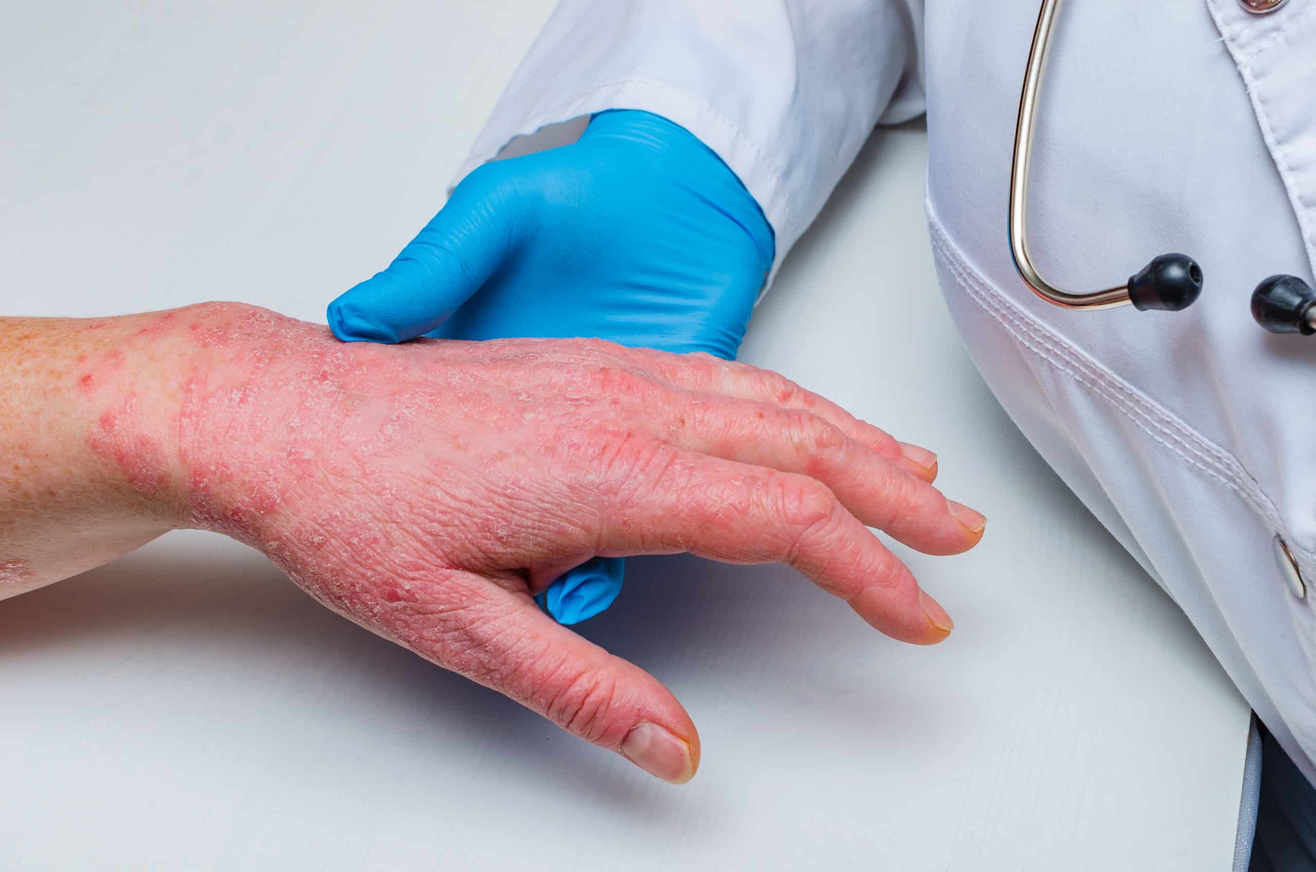 doctor in gloves examines the skin of the hand of a sick patient. Chronic skin diseases - psoriasis, eczema, dermatitis.