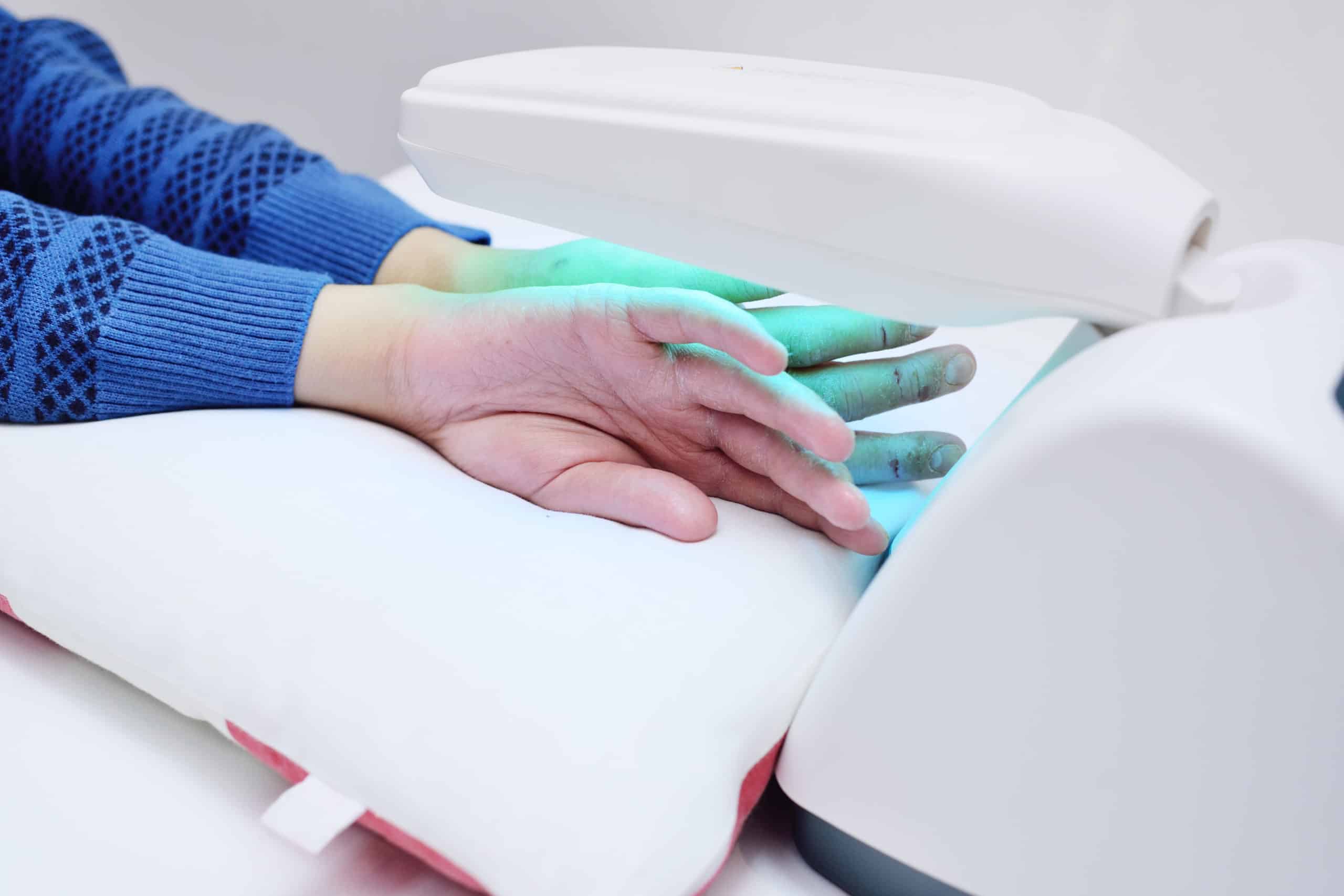 hands of a patient with psoriasis close-up under an ultraviolet lamp. Light therapy, phototherapy