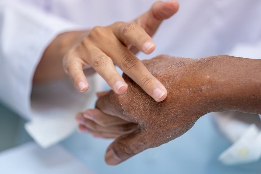 Selective focus close up woman pharmacist or doctor hand apply steroid moisturizer cream on old asian man hand with flaking dry itchy skin conditions peeling by allergic dermatitis.