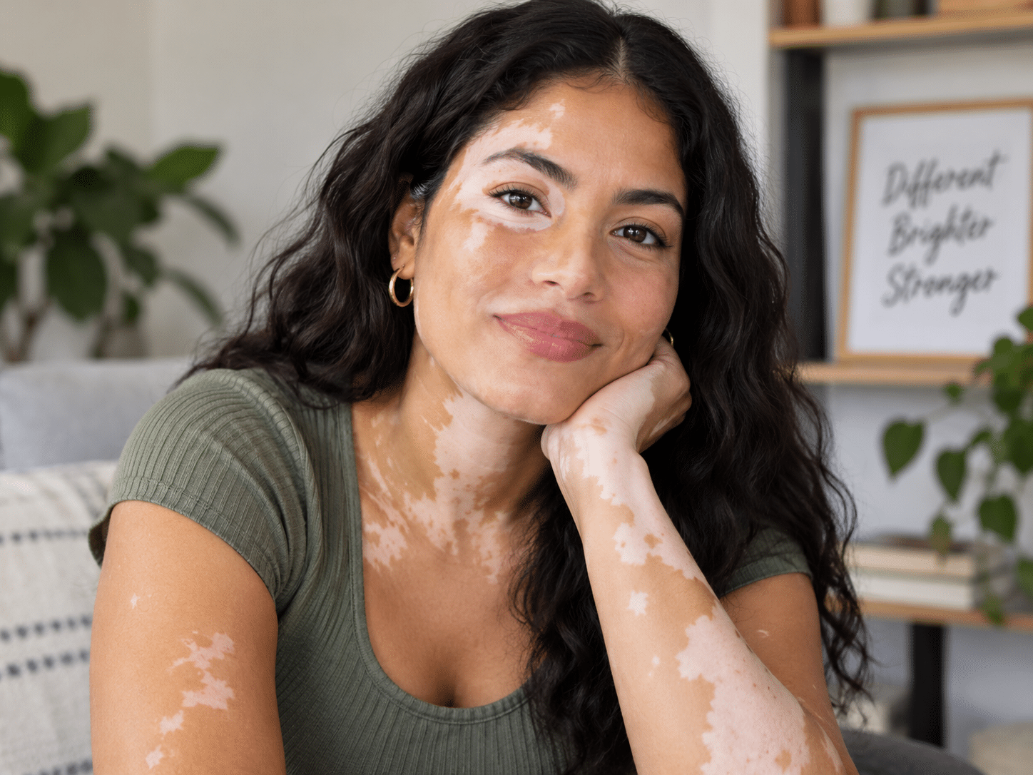 Vitiligo